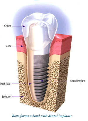 implantologie dentara