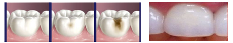 caria dentara, odontoterapia